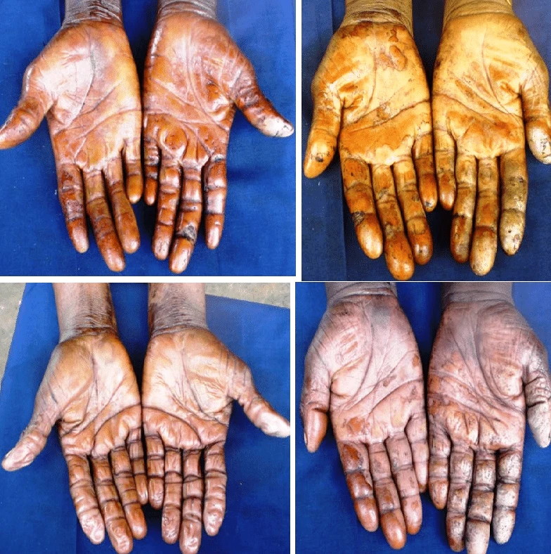Effect of CNSL 1
