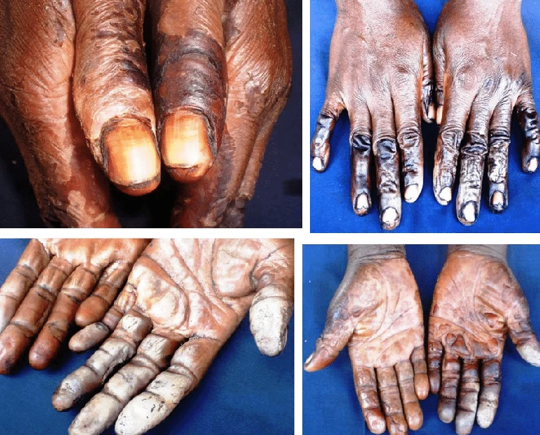 Effect of CNSL 2